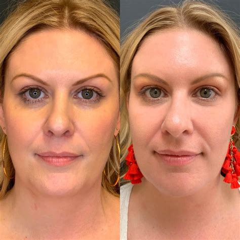 p shot before and after photos|PRP Injections Before & After Pictures .
